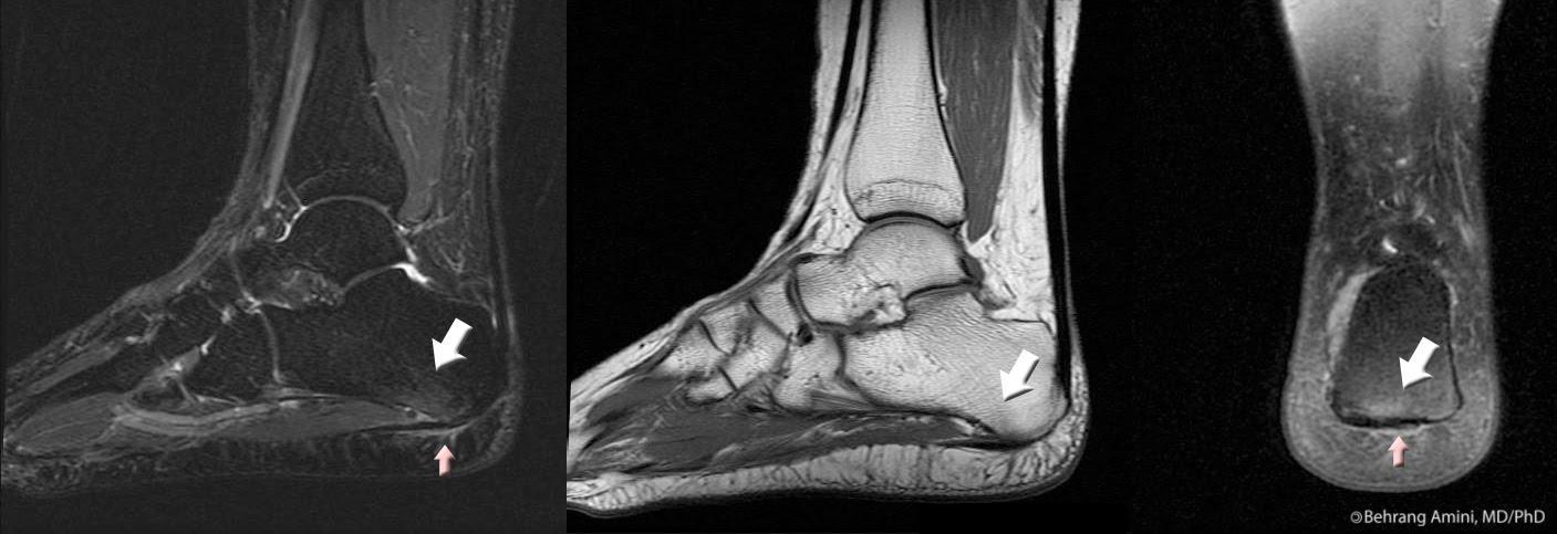 عکس رادیولوژی از پاشنه پا از بغل و پشت